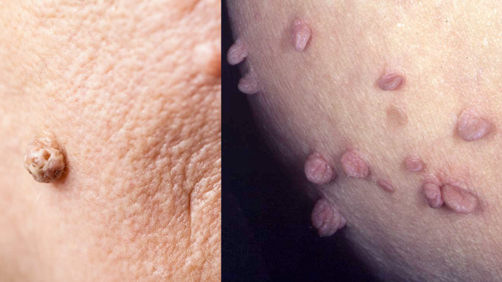 Painless way to get rid of skin tags