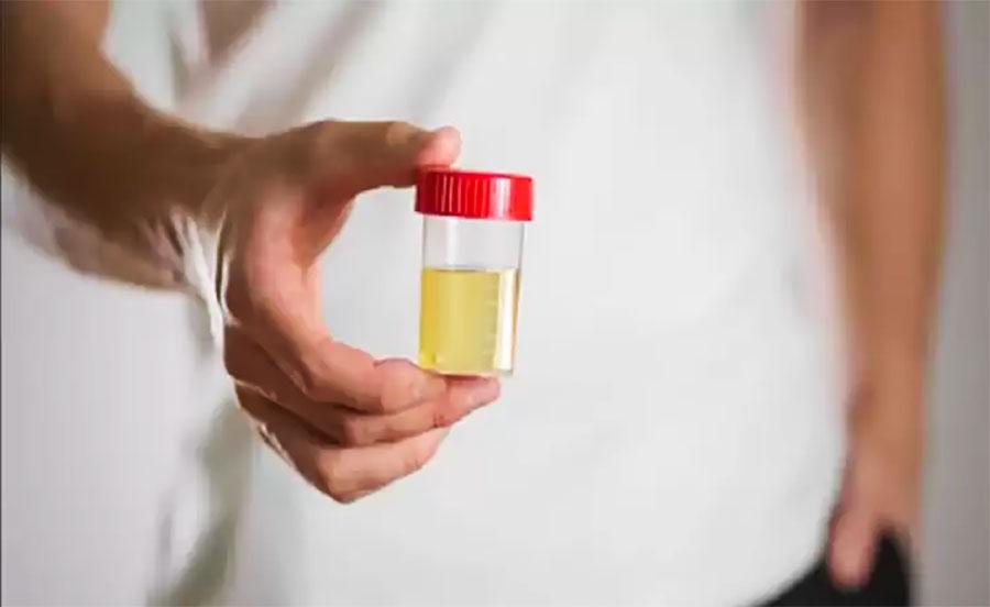 Change in the color of urine, it can be a sign of this serious disease!