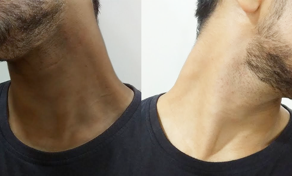 how to get rid of black neck