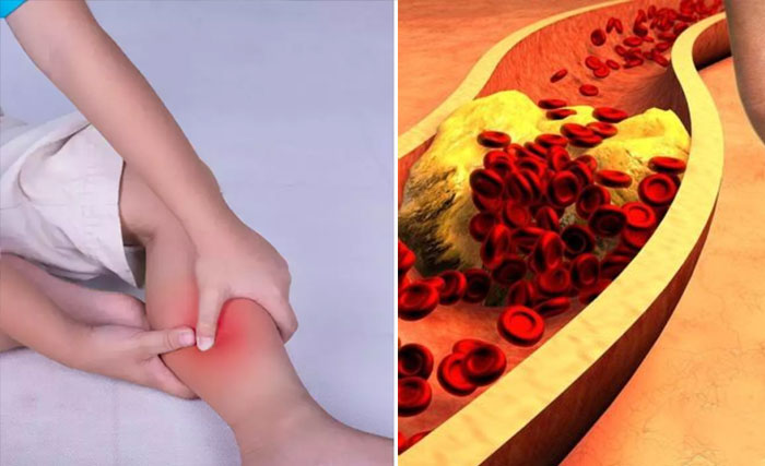 High Cholesterol Symptoms: When cholesterol increases our body gives 5 types of gestures