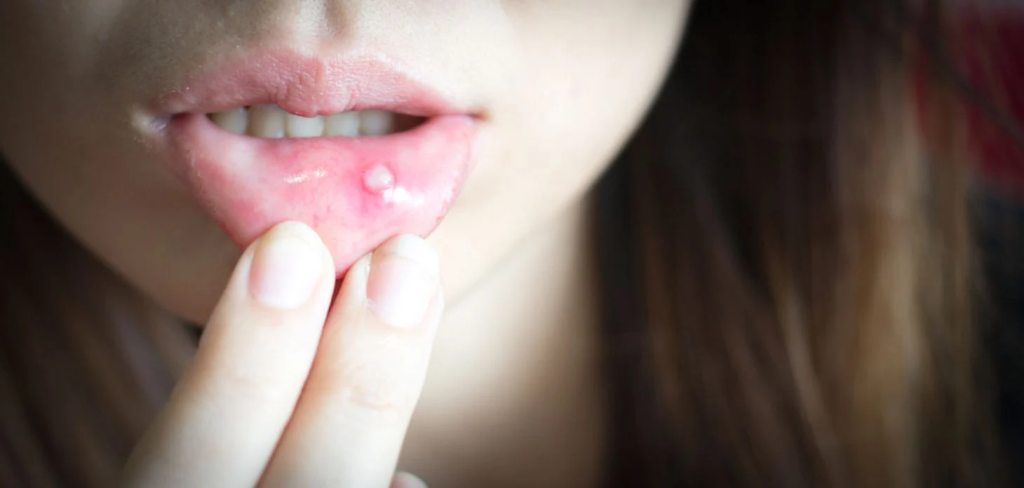 Mouth Ulcers