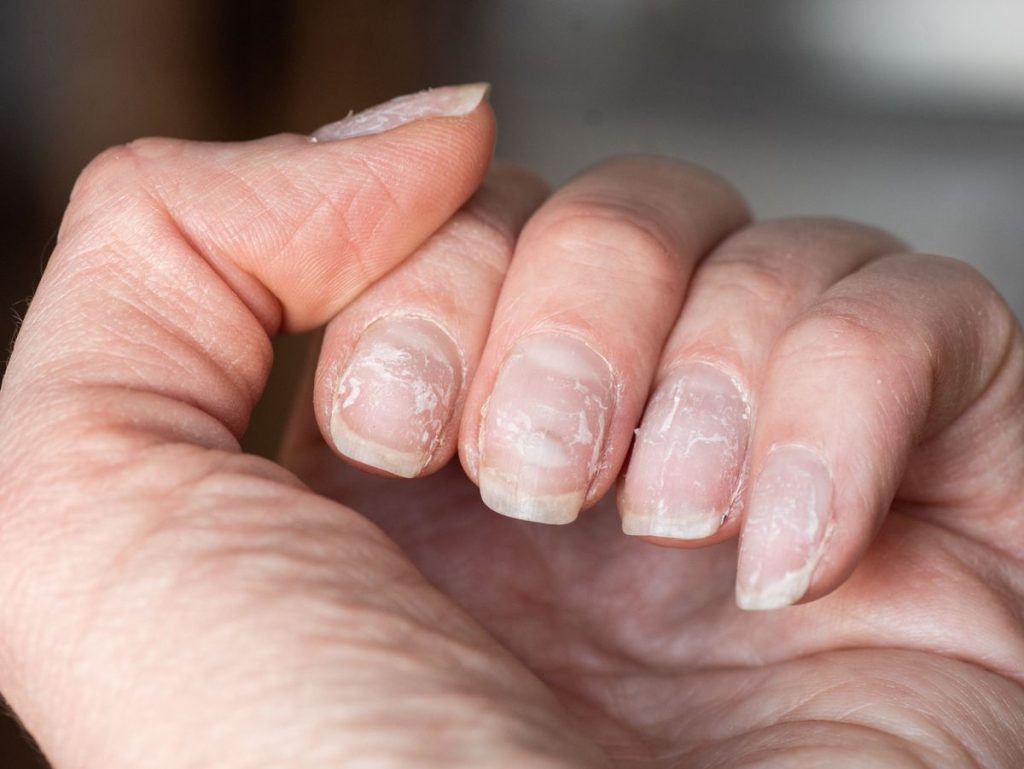 brittle nails