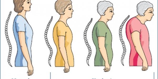 loss of height due to brittle bones