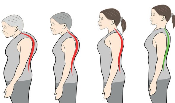 Worrying signs and symptoms of brittle bones in women: Prevention tips 10 stooped height