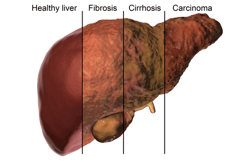 complications of fatty liver
