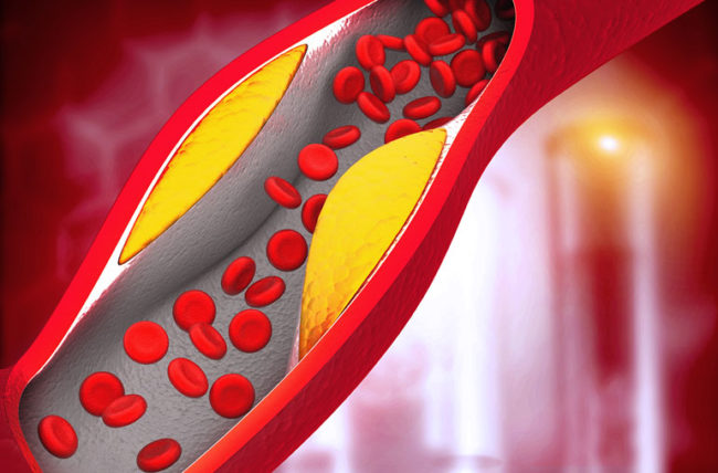 Unhealthy eating habits that raise bad cholesterol levels 2 unhealthy eating habits that can raise bad cholesterol levels