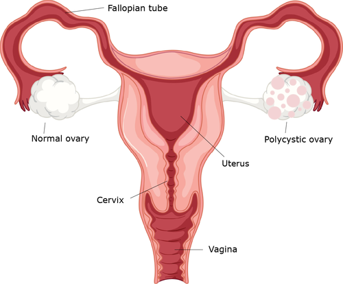 Tips to manage PCOS and its symptoms naturally 2 PCOS
