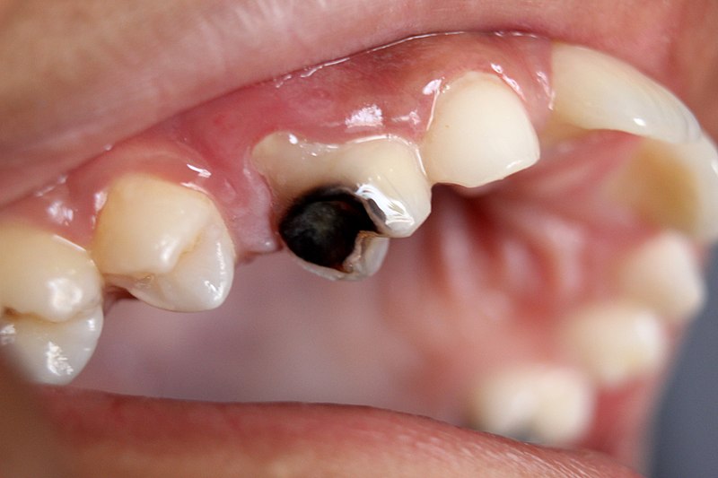 Intermittent fasting can prevent tooth decay 5 tooth decay
