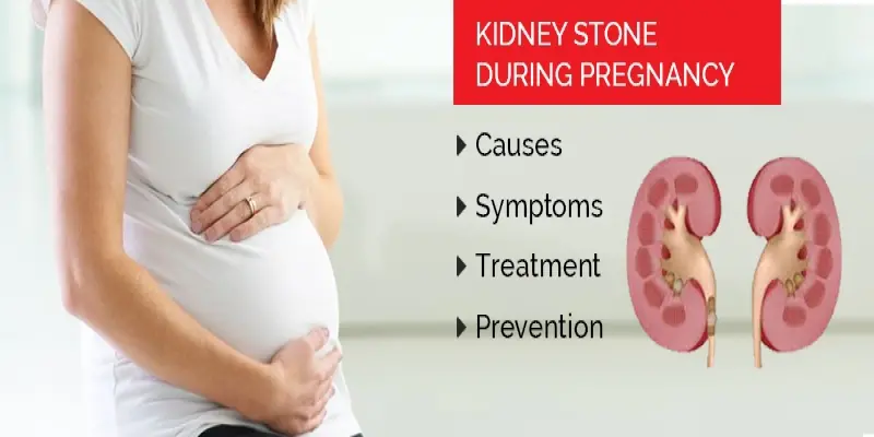 Kidney stones in pregnancy