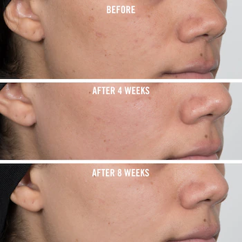 Why to add niacinamide in your skincare regime 6 Niacinamide