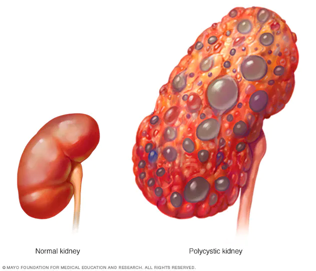 Kidney Disorders