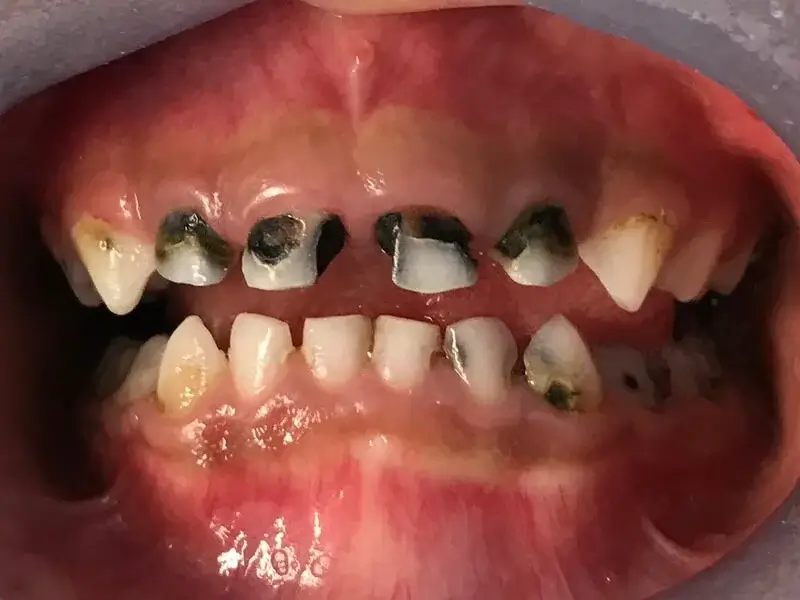 Cavities : Prevention, Common Causes of Tooth Decay in Children 8 Inadequate Nutrition