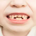 Cavities : Prevention, Common Causes of Tooth Decay in Children 2 Cavities : Prevention, Common Causes of Tooth Decay in Children
