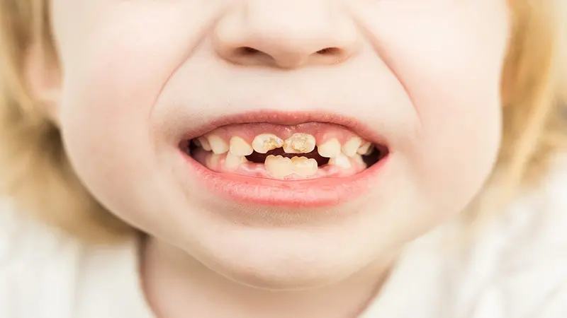 Cavities : Prevention, Common Causes of Tooth Decay in Children