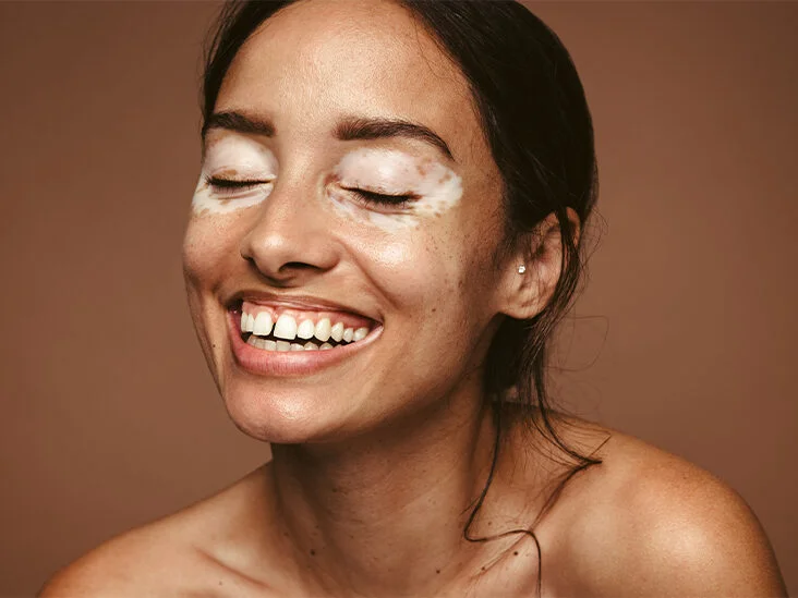 World Vitiligo Day 2023: Celebrating Diversity 6 Empowering Individuals with vitiligo