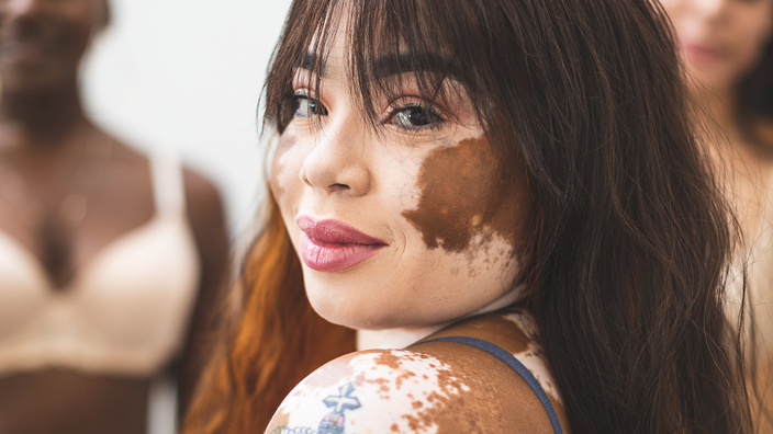 World Vitiligo Day 2023