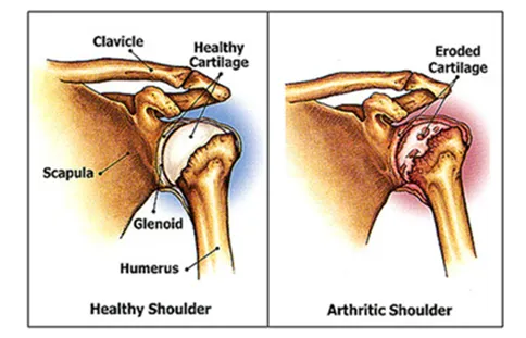 Osteoarthritis of the Shoulder