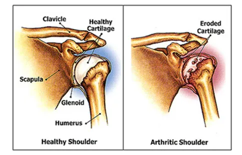 Shoulder Pain: Understanding the Causes 12 Osteoarthritis of the Shoulder
