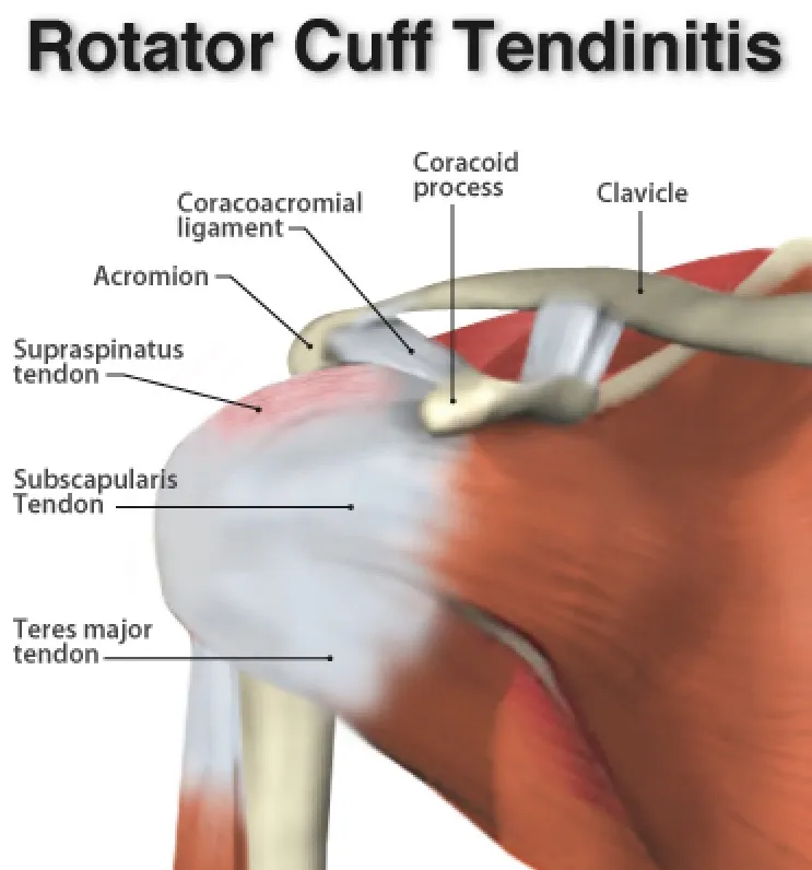 Shoulder Pain: Understanding the Causes 7 Rotator Cuff Tendinitis