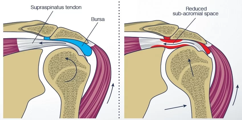 Shoulder Pain: Understanding the Causes 10 Shoulder Impingement Syndrome