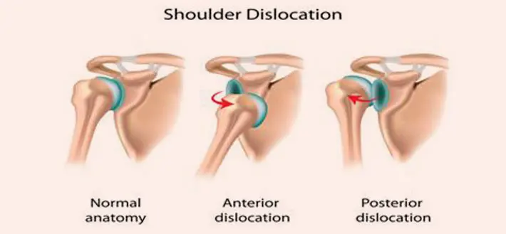 Shoulder Instability