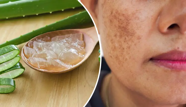 Aloe Vera for hyperpigmentation