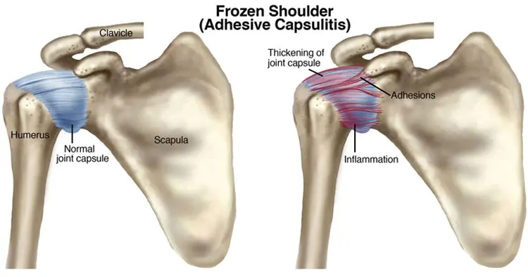 Frozen Shoulder (Adhesive Capsulitis) causes shoulder pain 