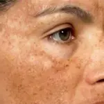 Hyperpigmentation: Natural Remedies for Even-Toned Skin 5 Hyperpigmentation: Natural Remedies for Even-Toned Skin