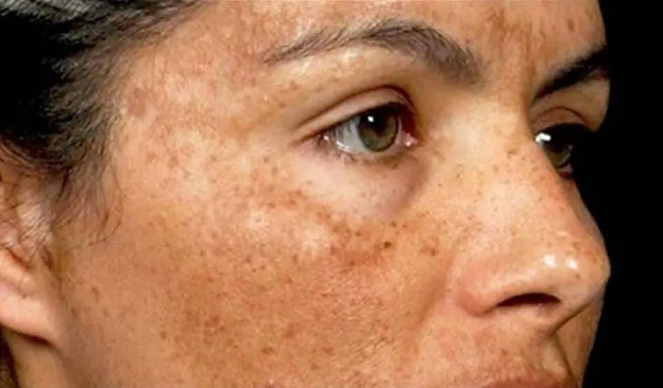 Hyperpigmentation: Natural Remedies for Even-Toned Skin