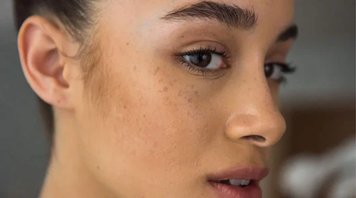 Hyperpigmentation: Natural Remedies for Even-Toned Skin 7 Hyperpigmentation