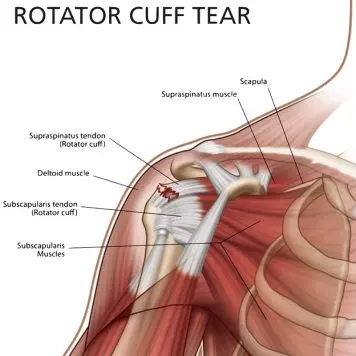 Shoulder Pain: Understanding the Causes 8 Rotator Cuff Tear