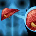 Liver Cancer