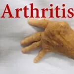Arthritis Problem is more common in women, some changes in lifestyle can prevent it