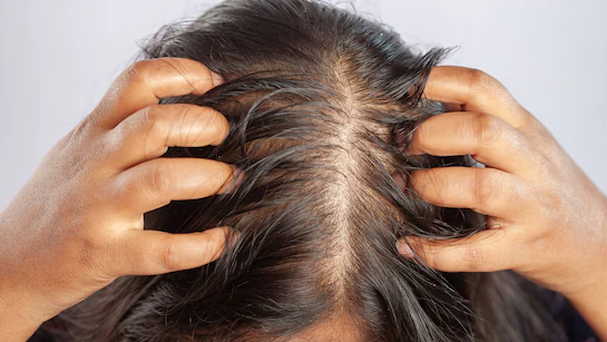 Coconut Oil Benefits: Mix These 2 Things for Hair Growth on Bald Head