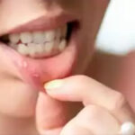 Mouth Ulcer Remedies