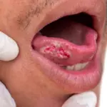 Recurring Mouth Sores or Wounds? They Could Be Early Signs of Mouth Cancer