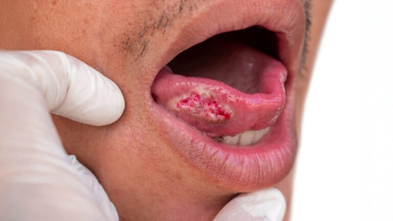 Recurring Mouth Sores or Wounds? They Could Be Early Signs of Mouth Cancer